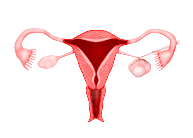 Ovarian Cyst