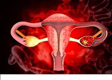 PCOS