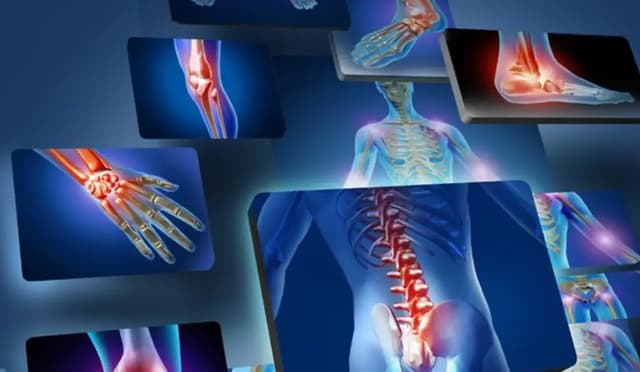 Rheumatoid Arthritis