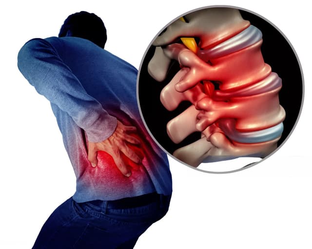 Sciatica